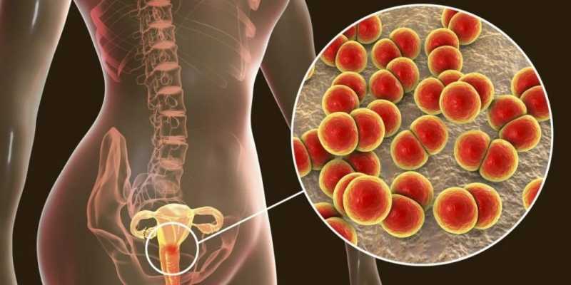 Pelvic Inflammatory Disease (PID) Penyebab, Gejala, dan Cara Mencegahnya