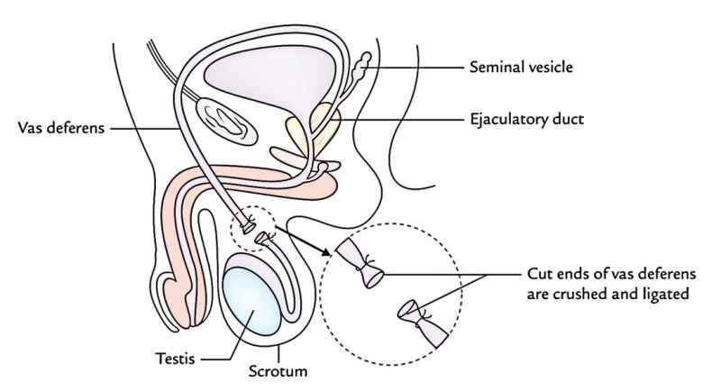 Vas Deferens